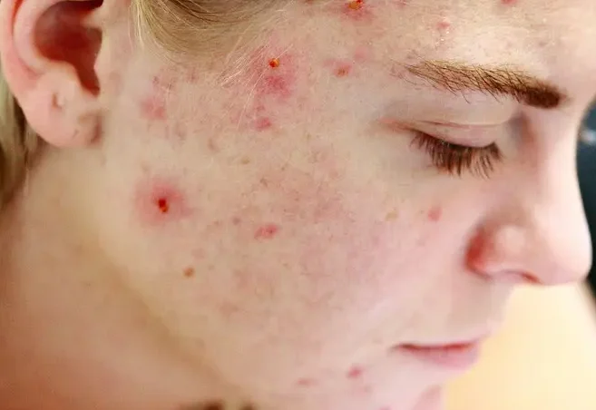 struggle, acne, self love, skin, face, portrait, woman, people, reality, girl, female, model, hair, person, human, skincare, character, caucasian, blemishes, pimples, no make up, life, problems, issues, self esteem, brown love, brown life, brown model, brown hair, brown human, acne, acne, acne, acne, acne, pimples, pimples