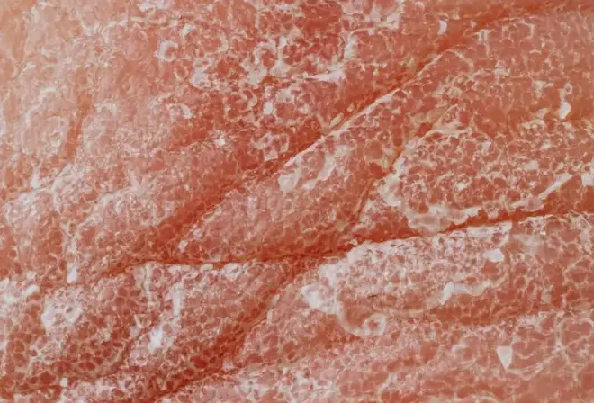 Detailed image highlighting dry, flaky skin texture for dermatological study.